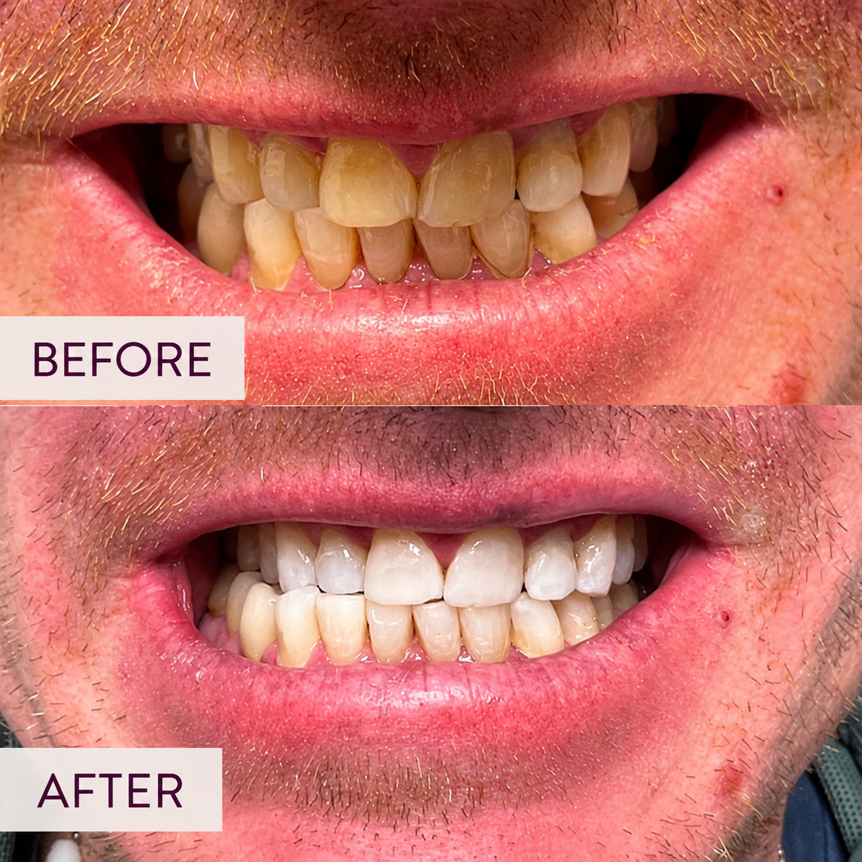 Before-and-after Beaming White teeth whitening showing improvement in tooth discoloration.