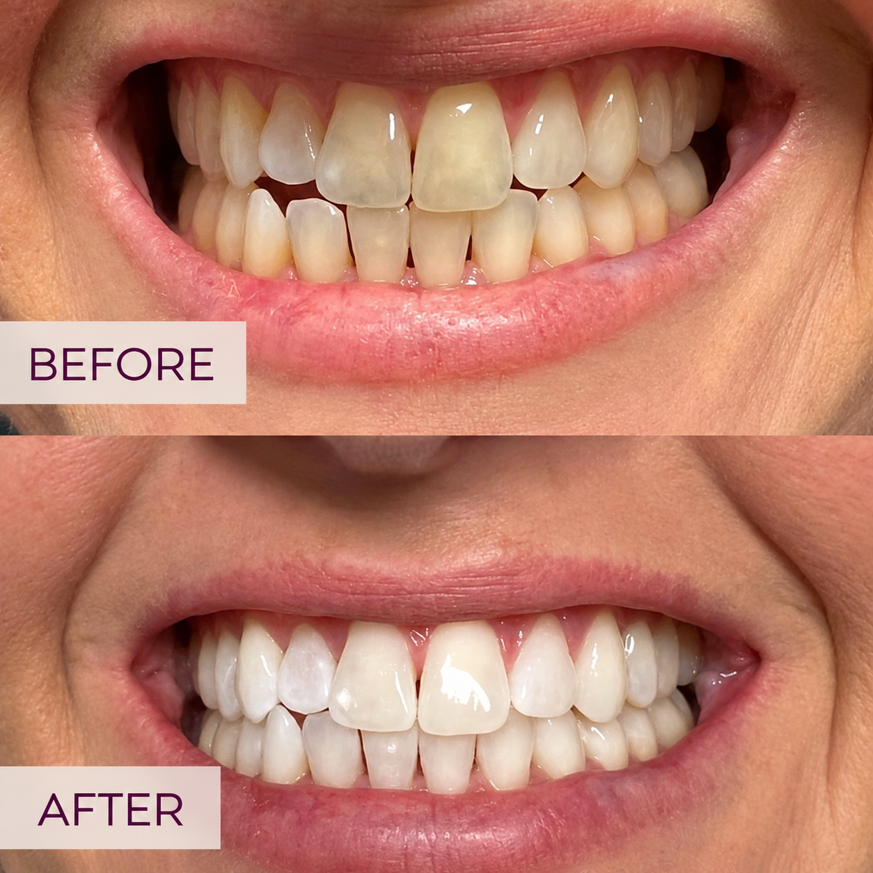 Before-and-after teeth whitening showing a brighter smile at ReJuvU Beauty Haven.