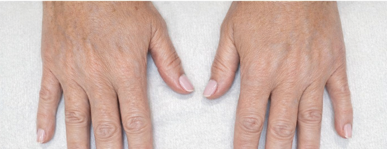 Natural Radiesse hand filler results for volume loss, serving the Layton and Davis County area