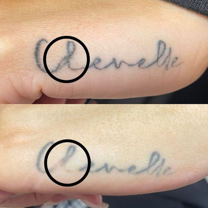 Laser tattoo removal treatment showing a cursive name tattoo fading on a patient's arm.