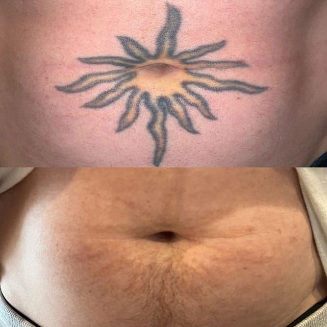 Close-up of a sun-shaped tattoo fading from laser removal treatments.