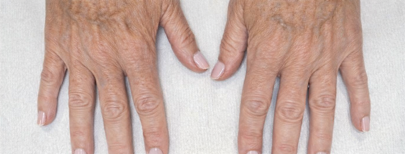 Natural Radiesse hand filler results for volume loss, serving the Layton and Davis County area