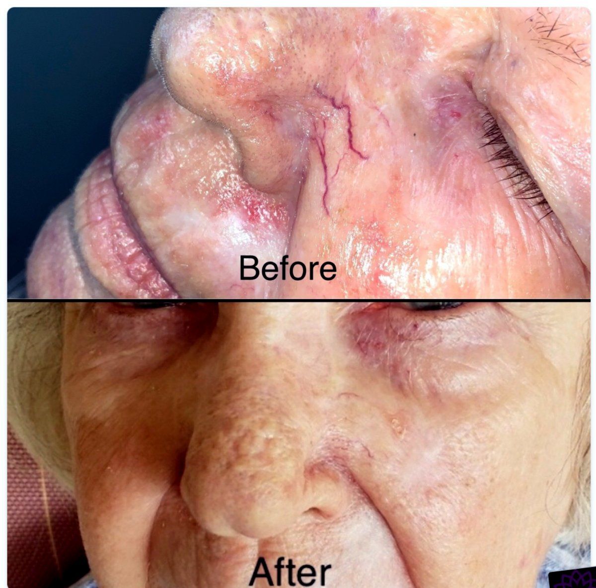 Before and after spider vein removal treatment on the face at a med spa in West Point, Utah serving Clearfield and Syracuse