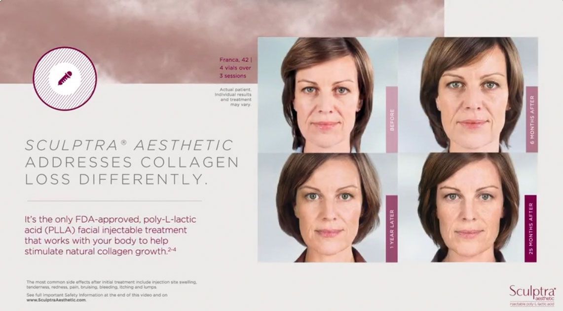 Before and after facial shots of a woman, showing the results of a Sculptra aesthetic collagen treatment.