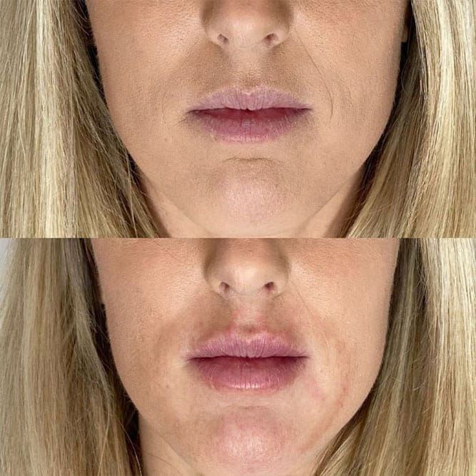 Facial filler before and after Layton Utah