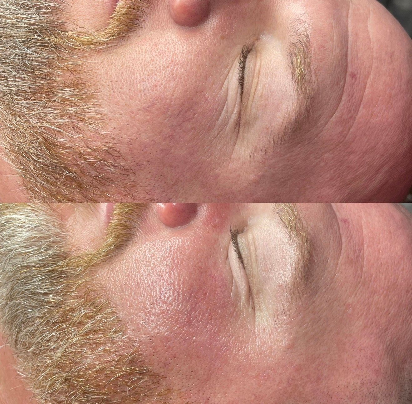 Hydrodermabrasion facial before and after results on a male patient near Clinton, UT