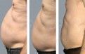 Three side-by-side images show a torso with decreasing belly size, possibly depicting weight loss.