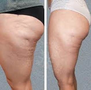 Before and after view of a thigh with cellulite reduction.