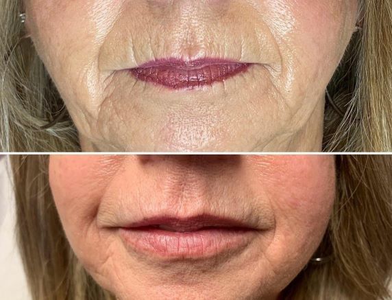 Before and after Juvederm lip filler treatment performed by Dr. Clayton Bass in West Point, Utah