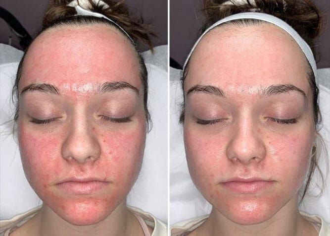 Before and after microneedling treatment for skin rejuvenation at a med spa in West Point, Utah serving Clinton and Syracuse