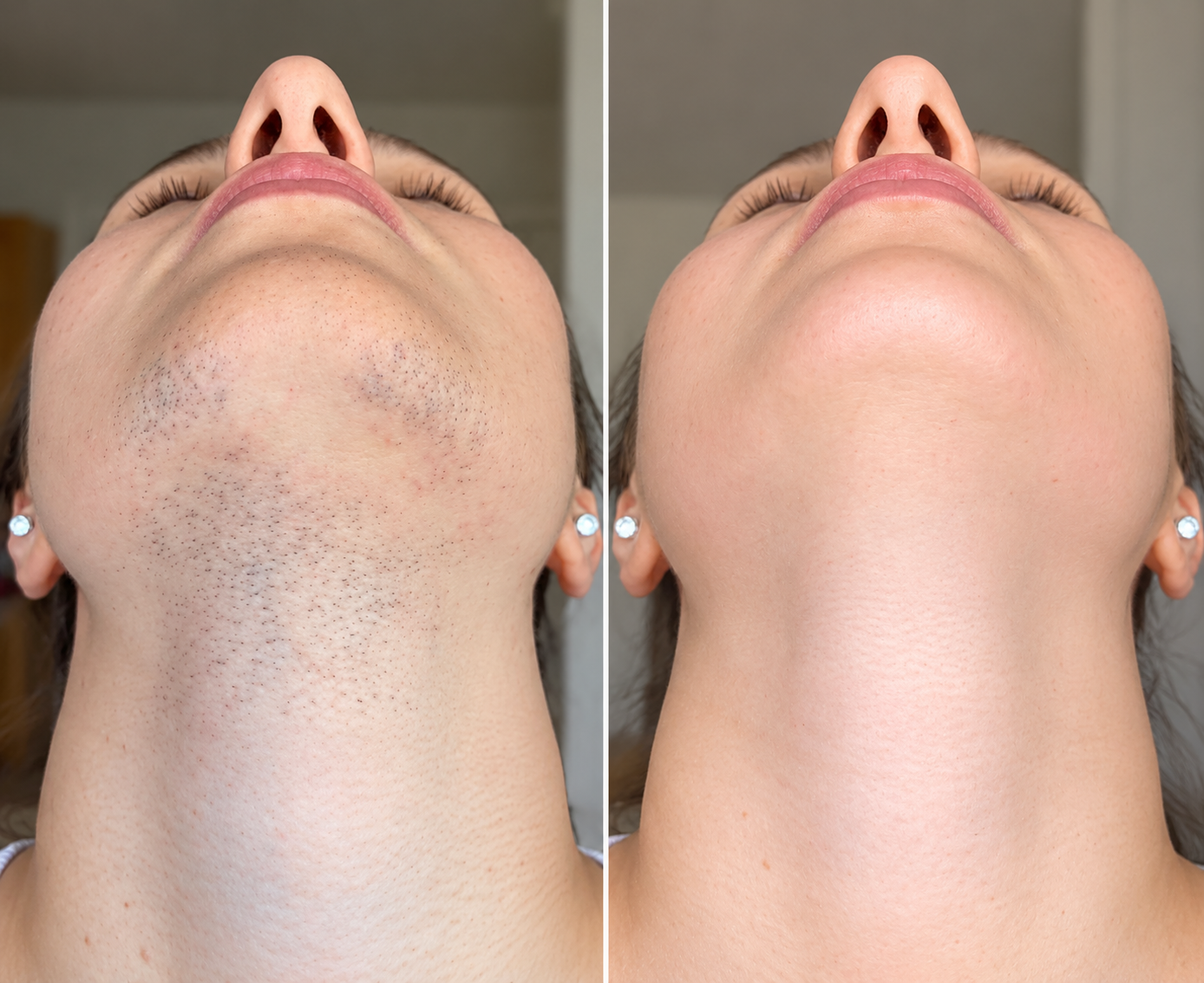 Before and after laser hair removal for PMOS (PCOS)-related facial hair