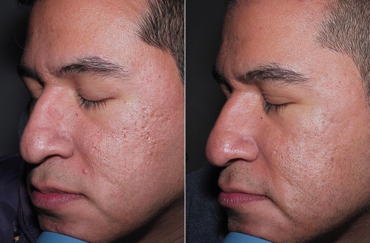 PiXel8-RF radiofrequency microneedling acne scar treatment results for patients in the Layton, UT area