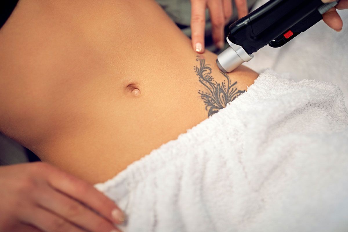 Laser treatment removing tattoo on person's hip. A hand aims device at dark ink on pale skin.
