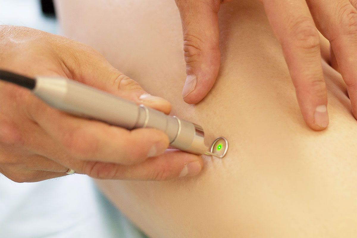 A laser hair removal device being used on skin; a close-up shot.