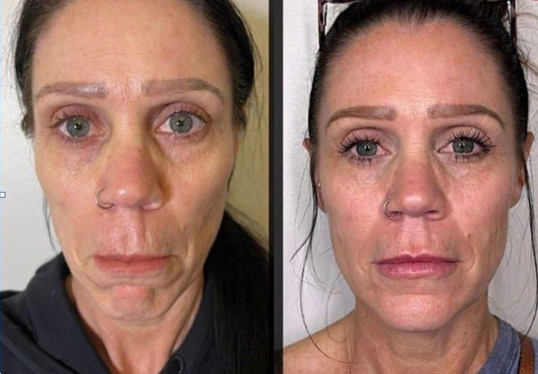 Sculptra before and after results showing natural volume restoration in West Point Utah
