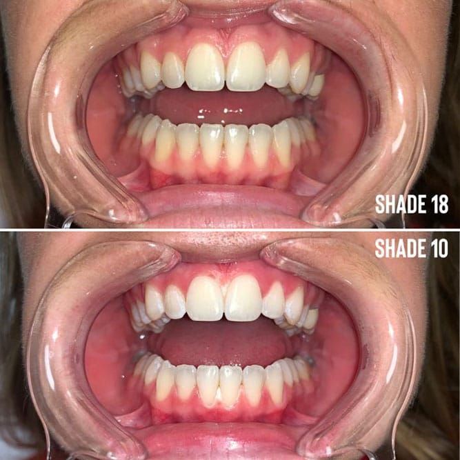 Teeth whitening