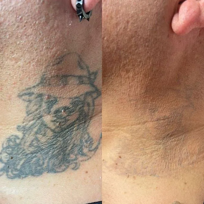 Side-by-side: tattoo of a bearded face with hat before and after laser removal, showing skin change.