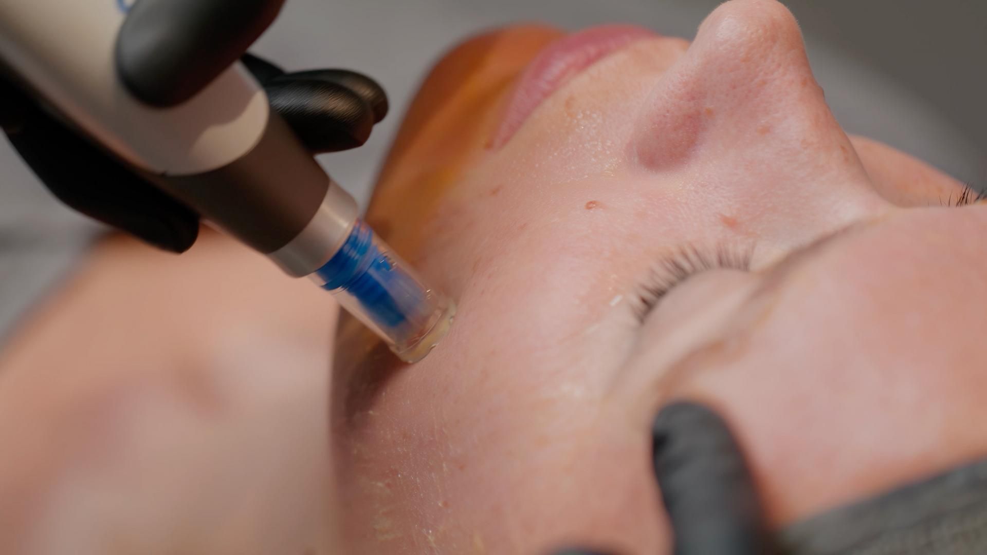 Microneedlingbehandeling op het voorhoofd met een penachtig apparaatje met een blauw getint puntje.