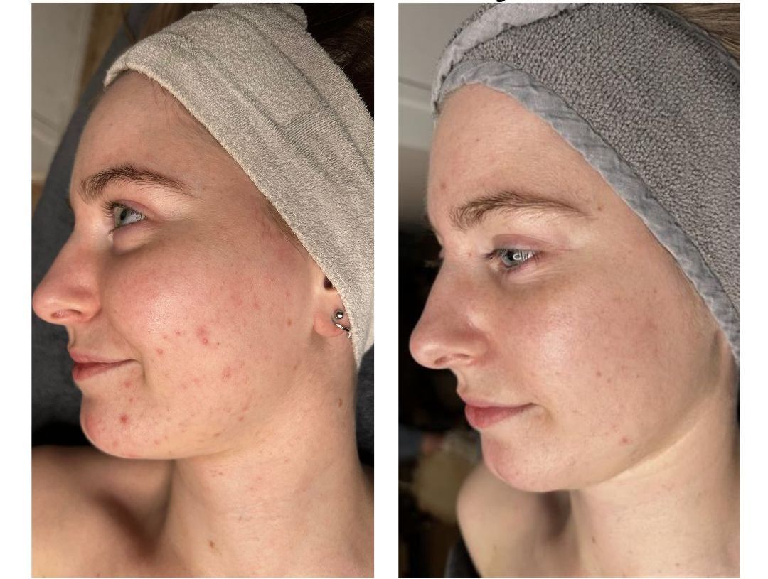 Naast elkaar geplaatste close-ups van gezichten, waarop links acne te zien is en rechts een egalere huid.