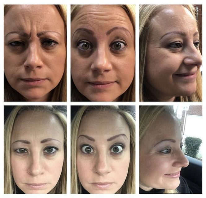 Before and after photos of a woman's face, showing wrinkles and expressions.