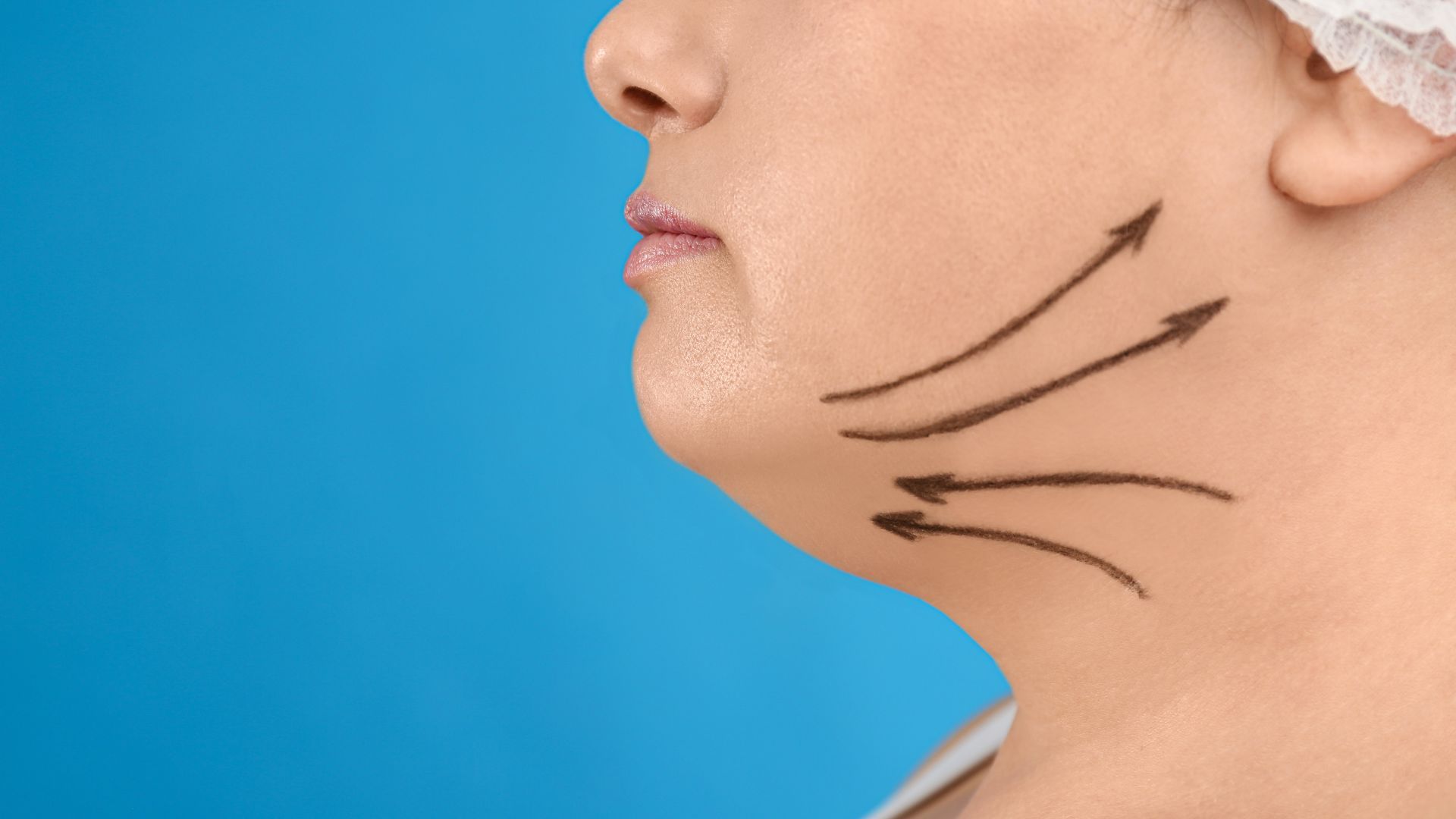 Kybella treatments in Snellville offer a non-surgical solution to reduce submental fat (double chin) for a defined jawline without the downtime of surgery.