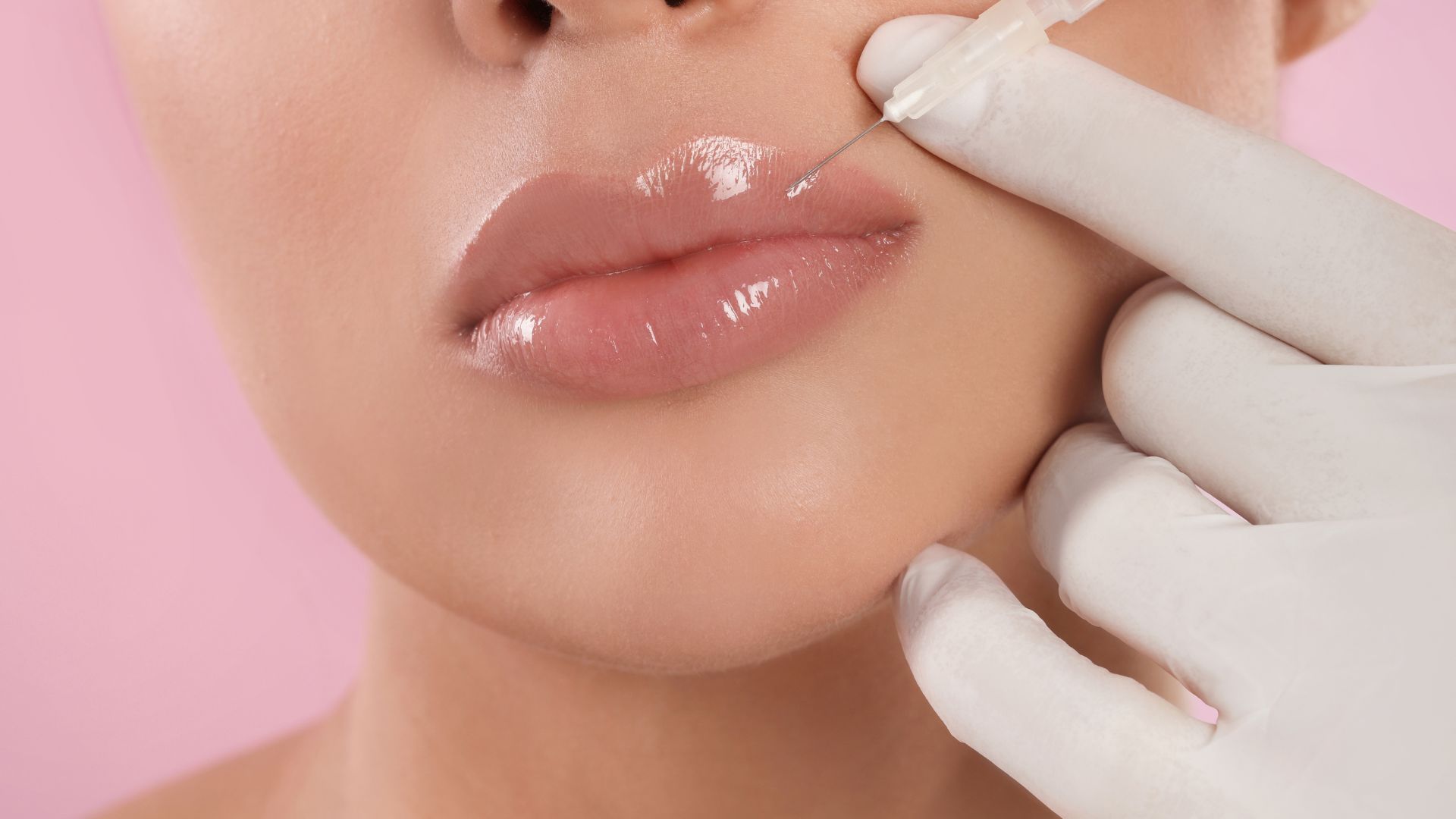 Achieve your desired lip volume and shape with our professional lip filler services, expertly administered in Snellville, GA.
