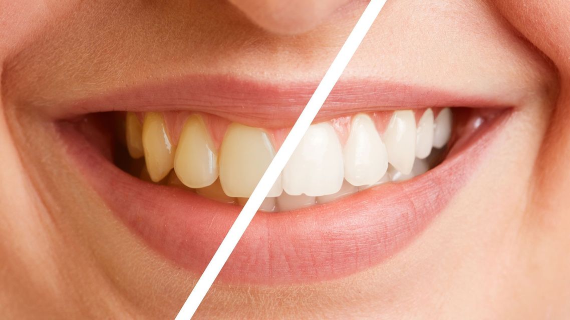 A before and after photo of a woman 's teeth.