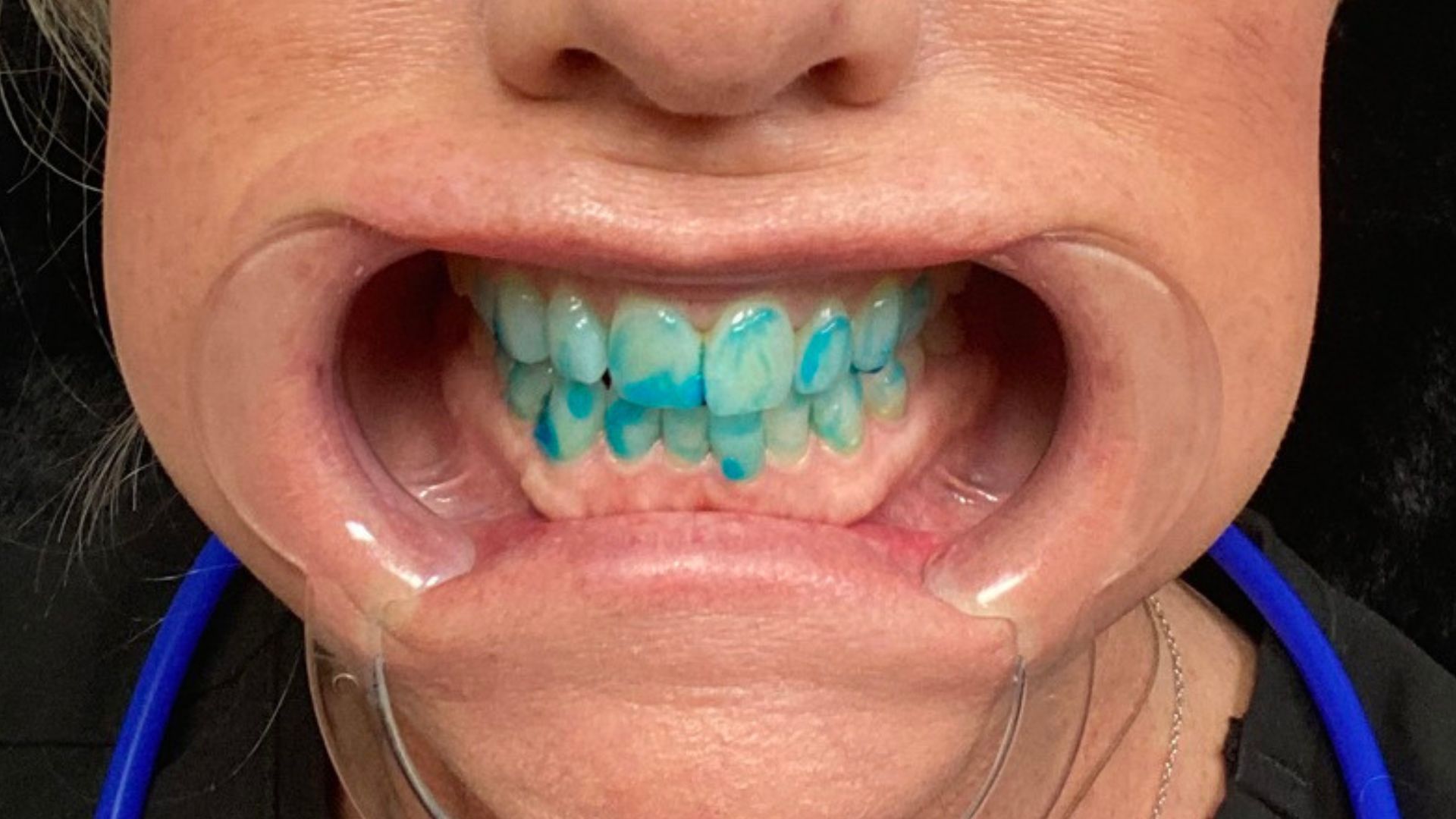 Teeth Whitening