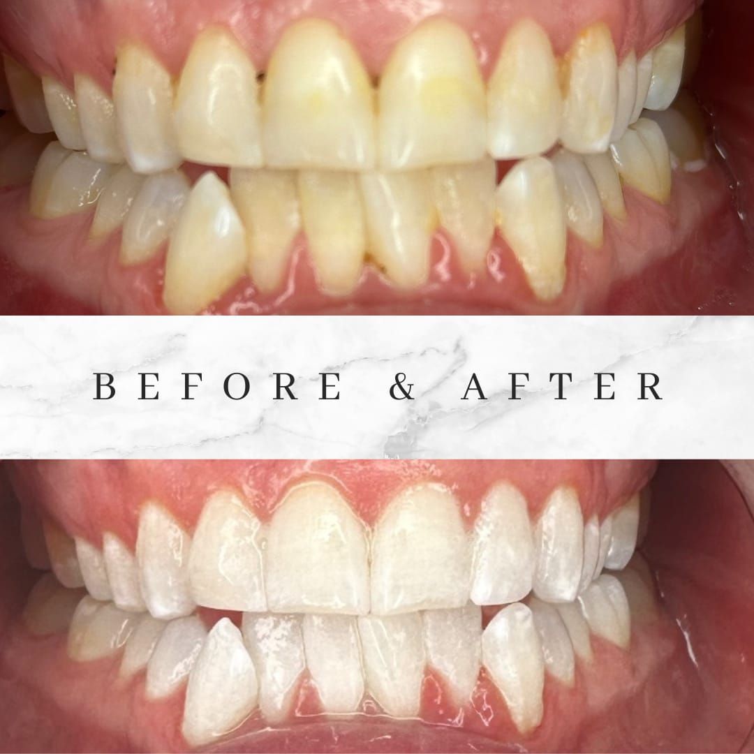 Side-by-side comparison of teeth, before and after whitening, showing a significant color change from yellow to white.
