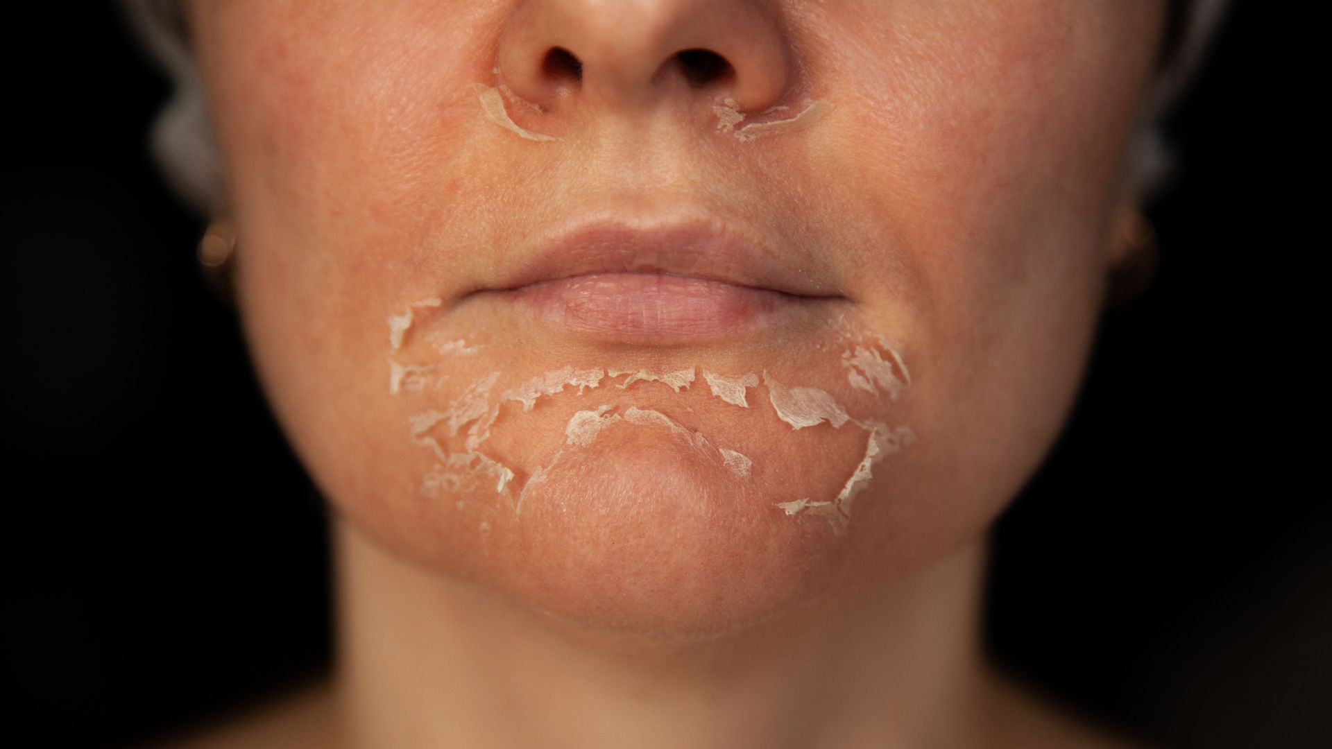 Our VI Peels in Snellville offer a unique blend of ingredients to effectively target signs of aging, hyperpigmentation, and acne.