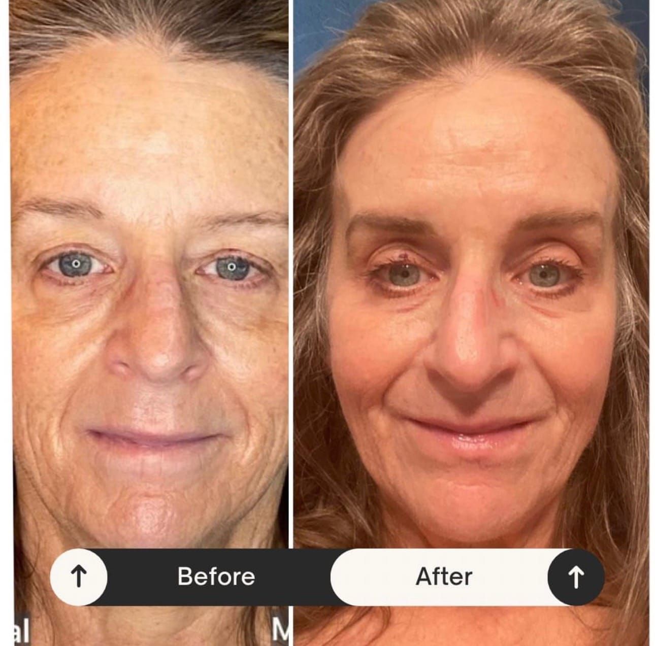 Side-by-side comparison of woman's face: before and after. Improved skin tone, fewer wrinkles, and brighter appearance.