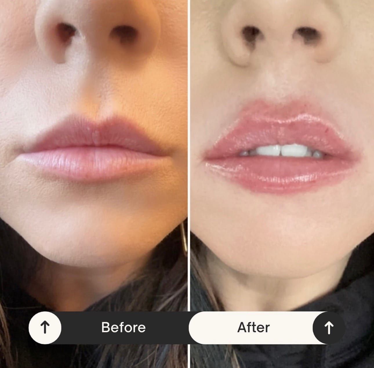 Side-by-side photo: Before and after lip filler injections. Fuller lips in the
