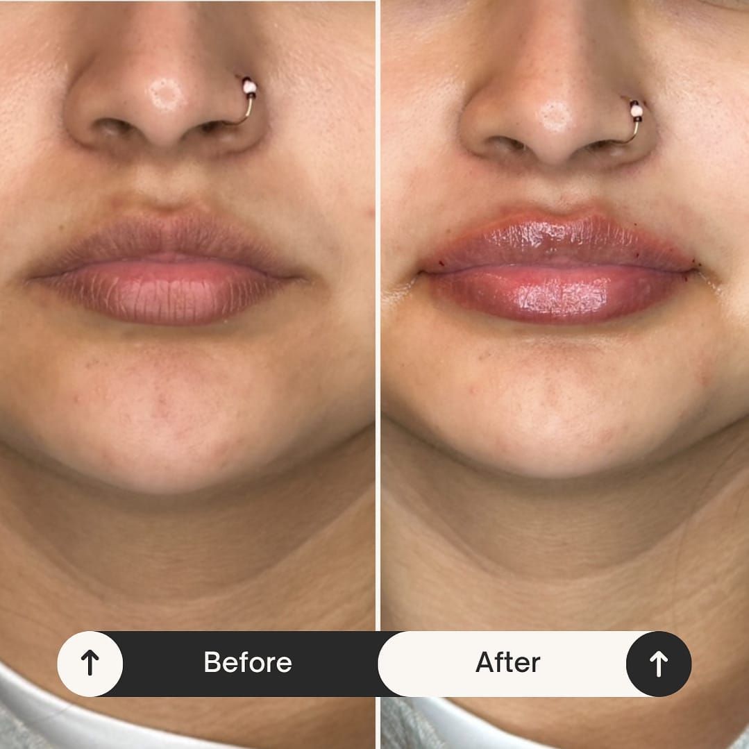 Side-by-side comparison: Before and after lip filler on a person with nose piercings, showing a noticeable increase.