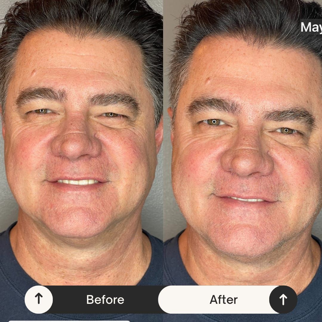 Side-by-side comparison of a man’s face before and after a cosmetic procedure. Smoother skin and less noticeable wrinkles.