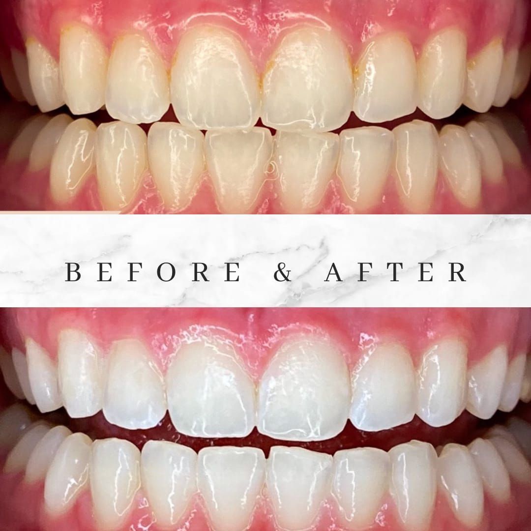 Before and after teeth whitening comparison: upper and lower rows of teeth, whiter after treatment.