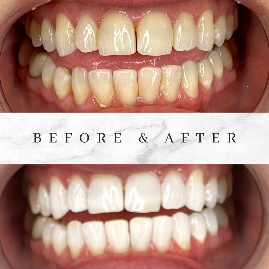 Before and after teeth whitening comparison. Yellowish teeth brighten to white.