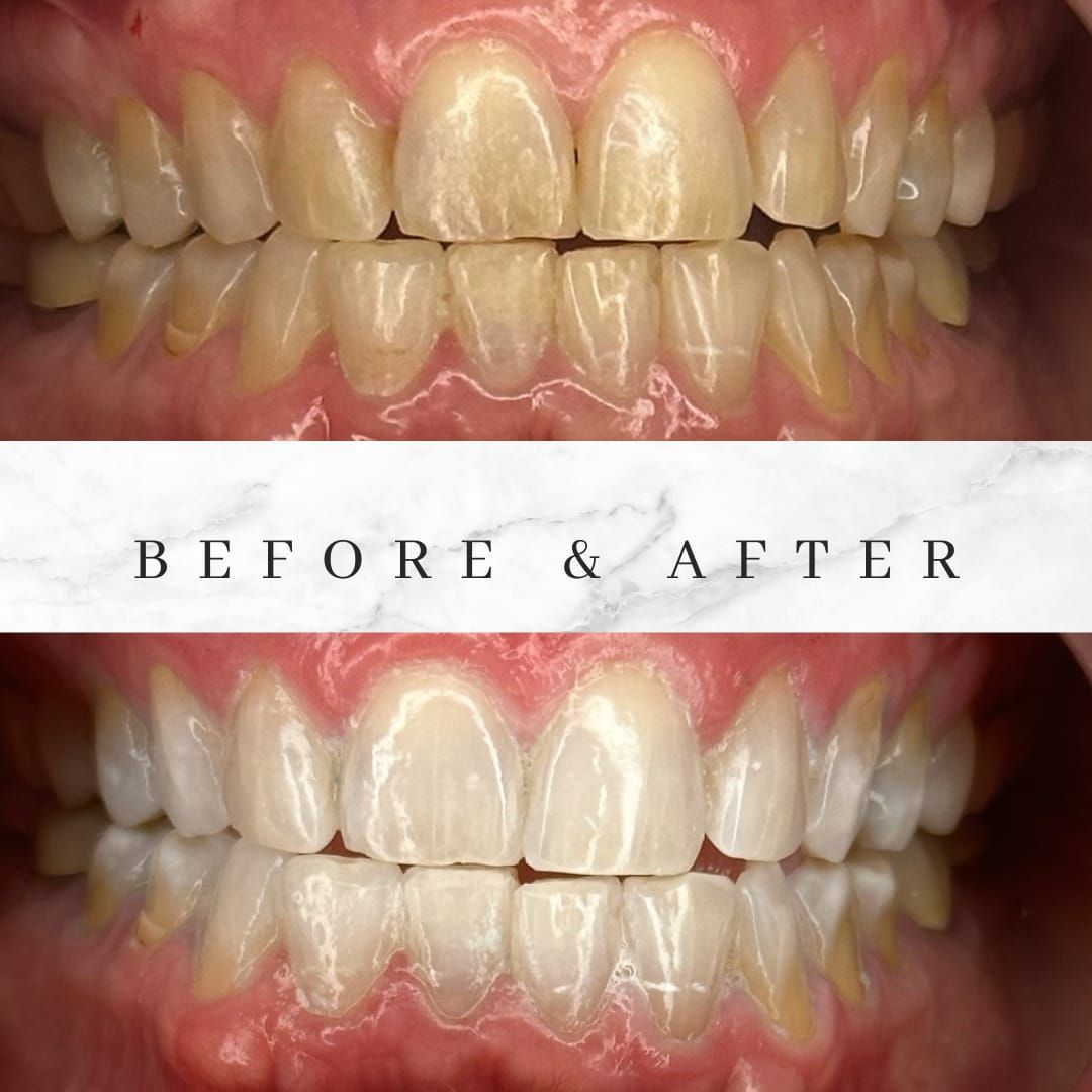 Teeth whitening: Before & After. Top row: yellowed teeth. Bottom row: bright white teeth.