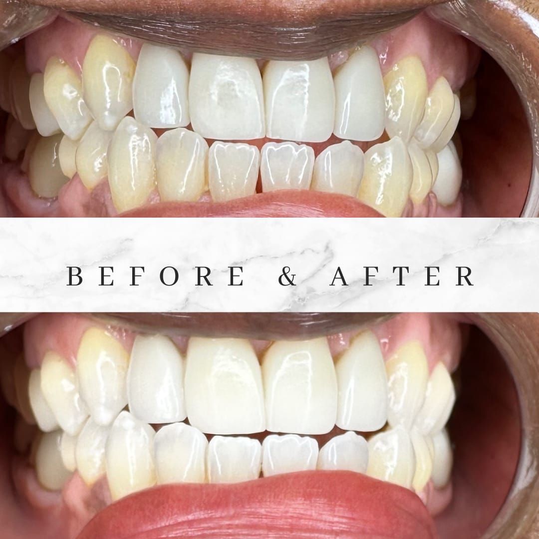 Comparison of teeth before and after whitening, with visible color difference.