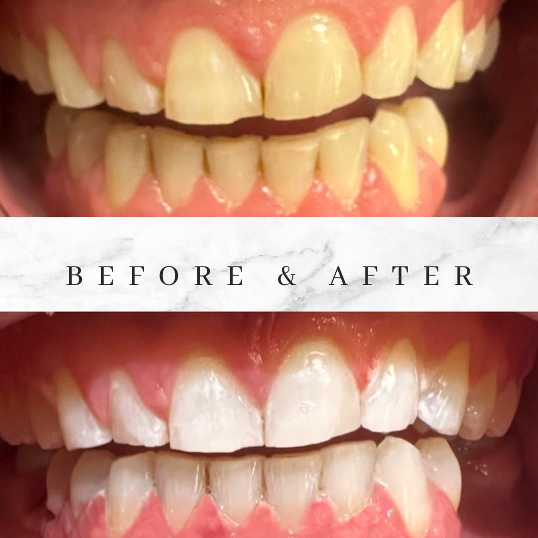 Before and after of teeth whitening: yellow teeth turn bright white, showing gum detail.