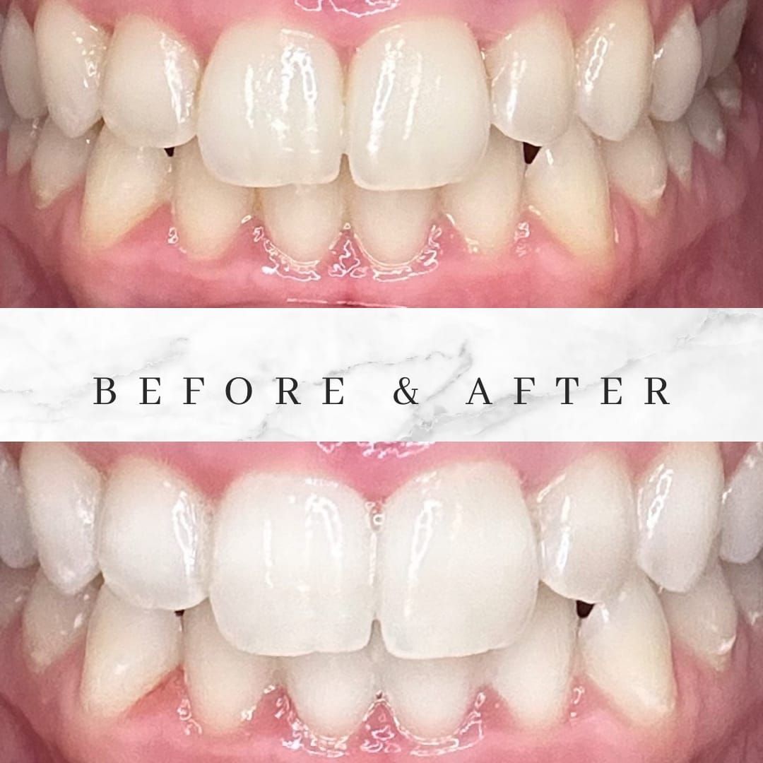 Side-by-side comparison of teeth, before and after a whitening treatment. Brighter, whiter teeth are shown.
