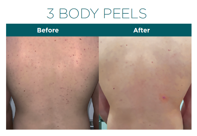 Our Back Peels in Snellville involve the application of a chemical solution to peel away the top layers of skin, revealing smoother, clearer skin underneath.