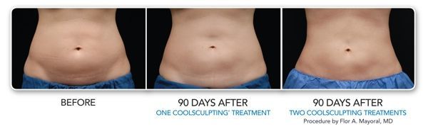 a before and after picture of a woman 's stomach