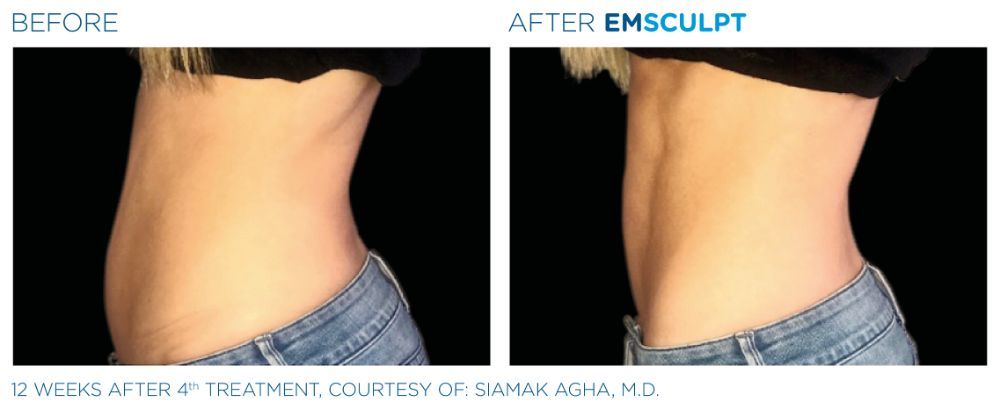 photos of a woman's torso. before on the left and after on the right after Emscumpt treatment. his abs are now more defined.