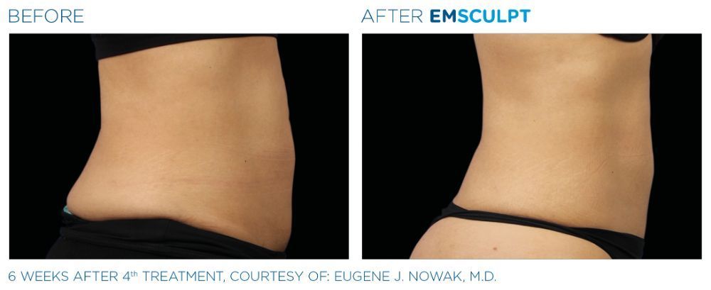 photos of a woman's torso. before on the left and after on the right after Emscumpt treatment. her figure now more defined.