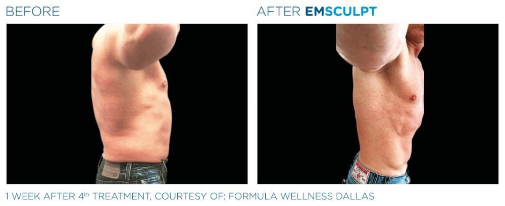 photos of a man's torso. before on the left and after on the right after Emscumpt treatment. his abs are now more defined.