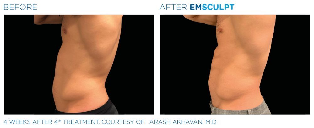 photos of a man's torso. before on the left and after on the right after Emscumpt treatment. his abs are now more defined.
