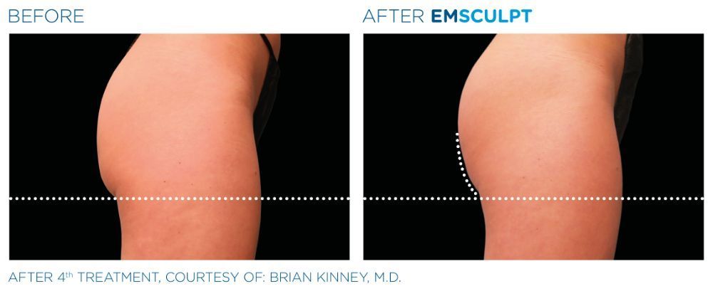 a picture of a woman's buttock before and after Emsculpt treatment