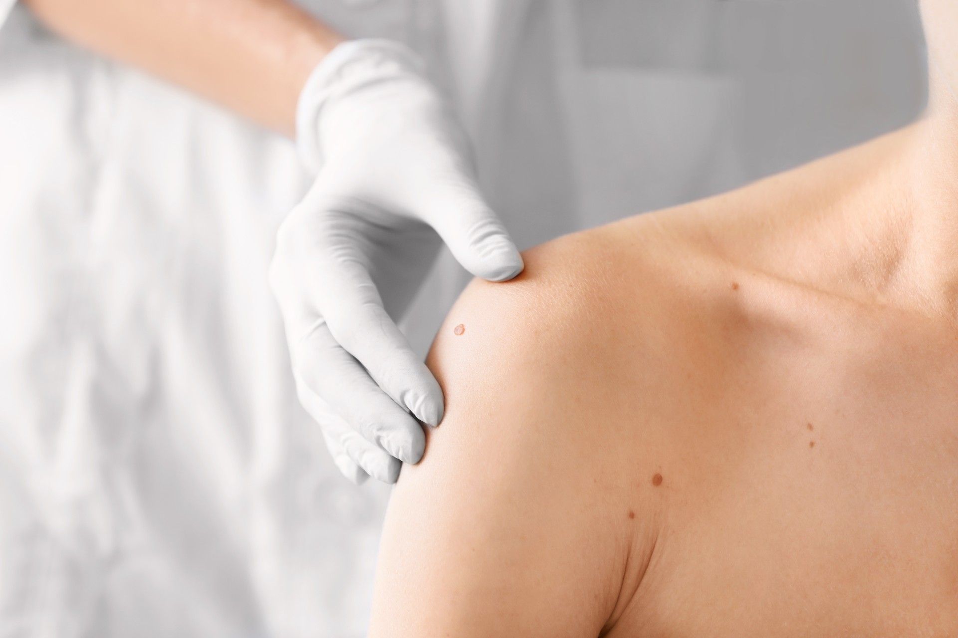 close up shot of a mole on a patient's shoulder being examined by a hand wearing a gloves