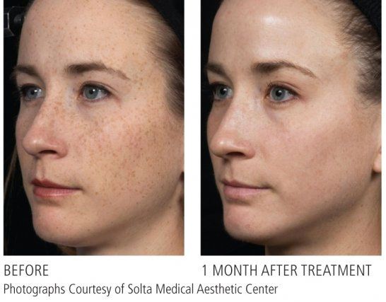 a before and after portrait of a woman's facing right after getting laser resurfacing treatment