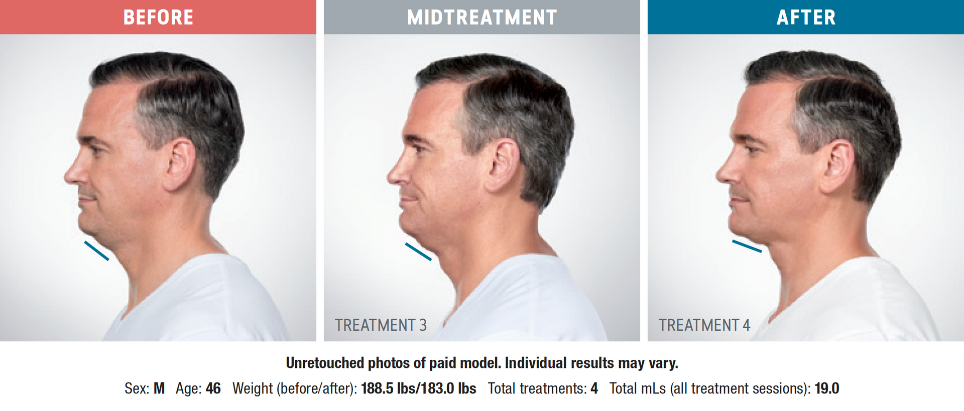 three pictures of a man 's neck before and after treatment with Kybella double chin injectable.
